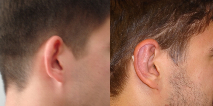 Otoplasty, after 7 days